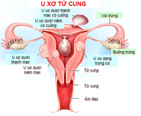 U xơ tử cung - Hình ảnh minh họa